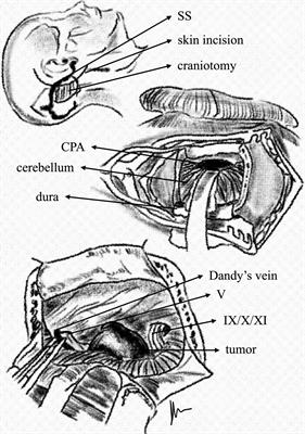 The Bigger the Better? Analysis of Surgical Complications and Outcome of the Retrosigmoid Approach in 449 Oncological Cases